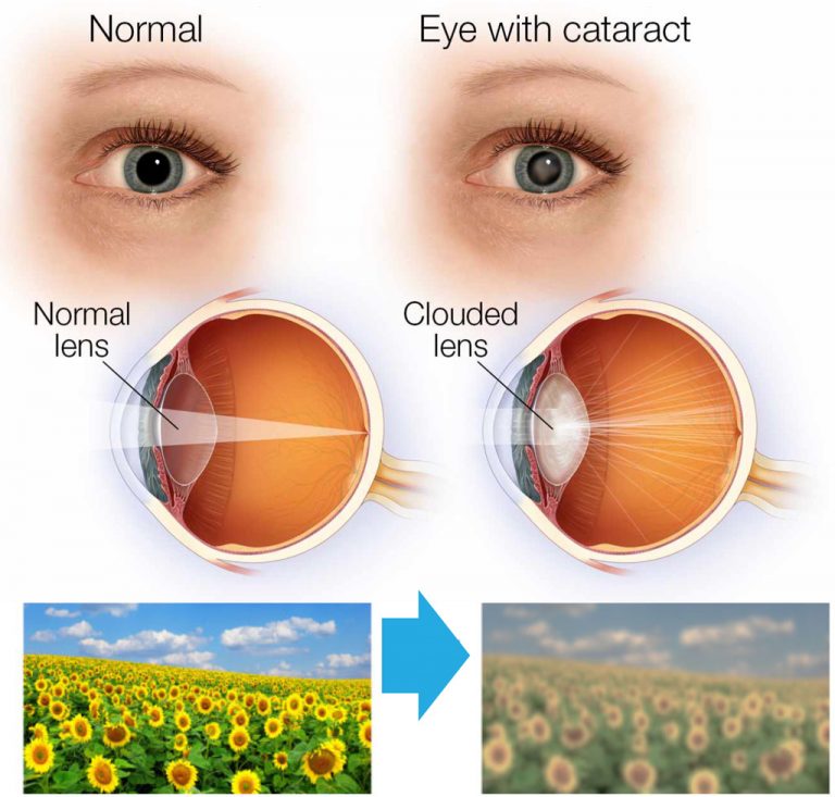 Cataract Surgery in Baramati