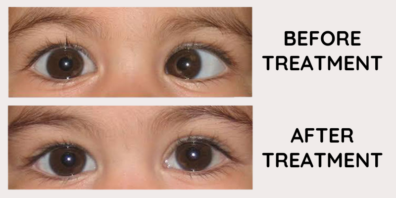 Squint Eye Treatment in Baramati | Prisma Eye Care