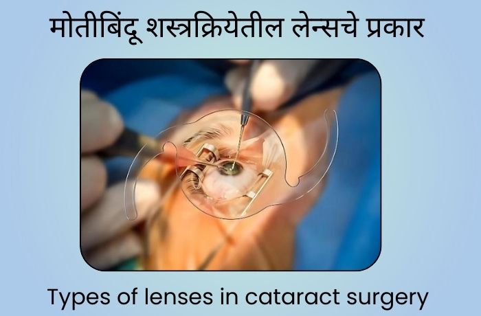 मोतीबिंदू शस्त्रक्रियेतील लेन्सचे प्रकार | Types of lenses in cataract surgery